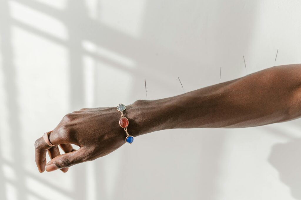 A close-up shot of a hand wearing a gemstone bracelet with acupuncture needles on the arm.